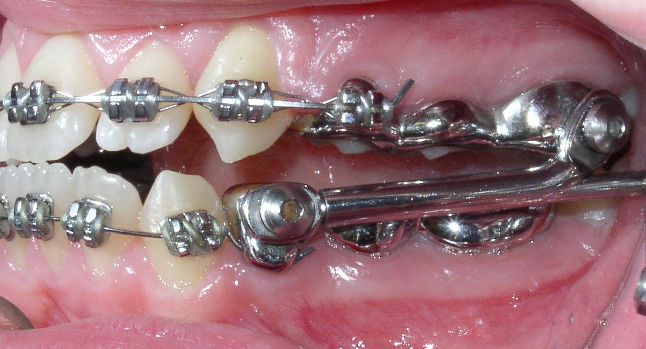 Herbst Class II treatment
