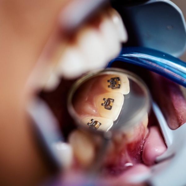 Lingual orthodontics