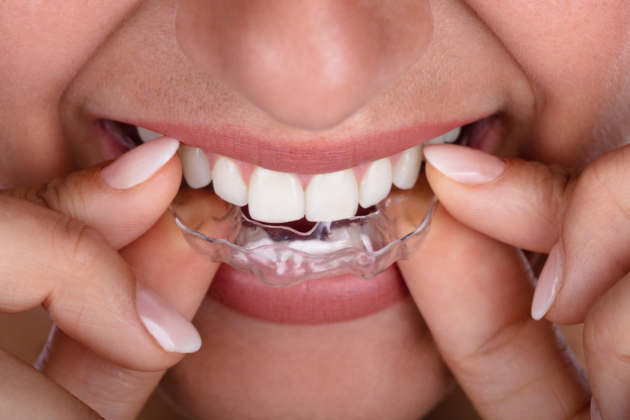 Διαφανείς νάρθηκες: Invisalign – ClearCorrect