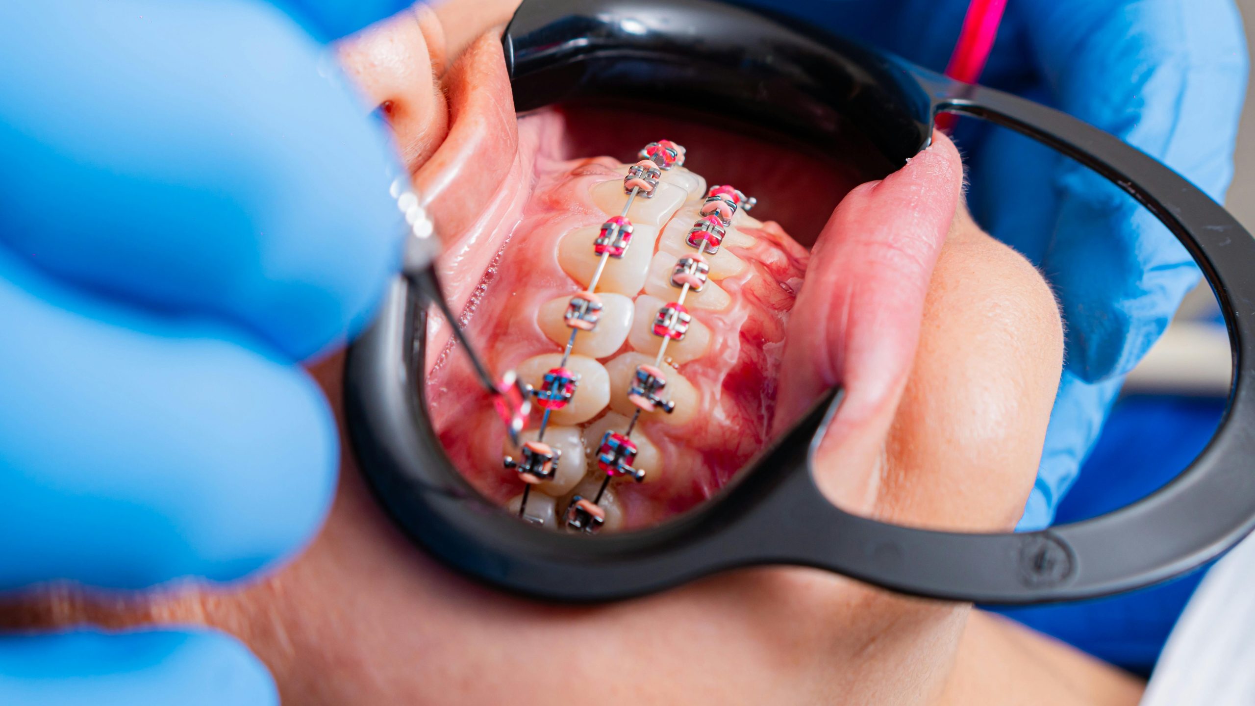 Orthodontic two-phase treatment