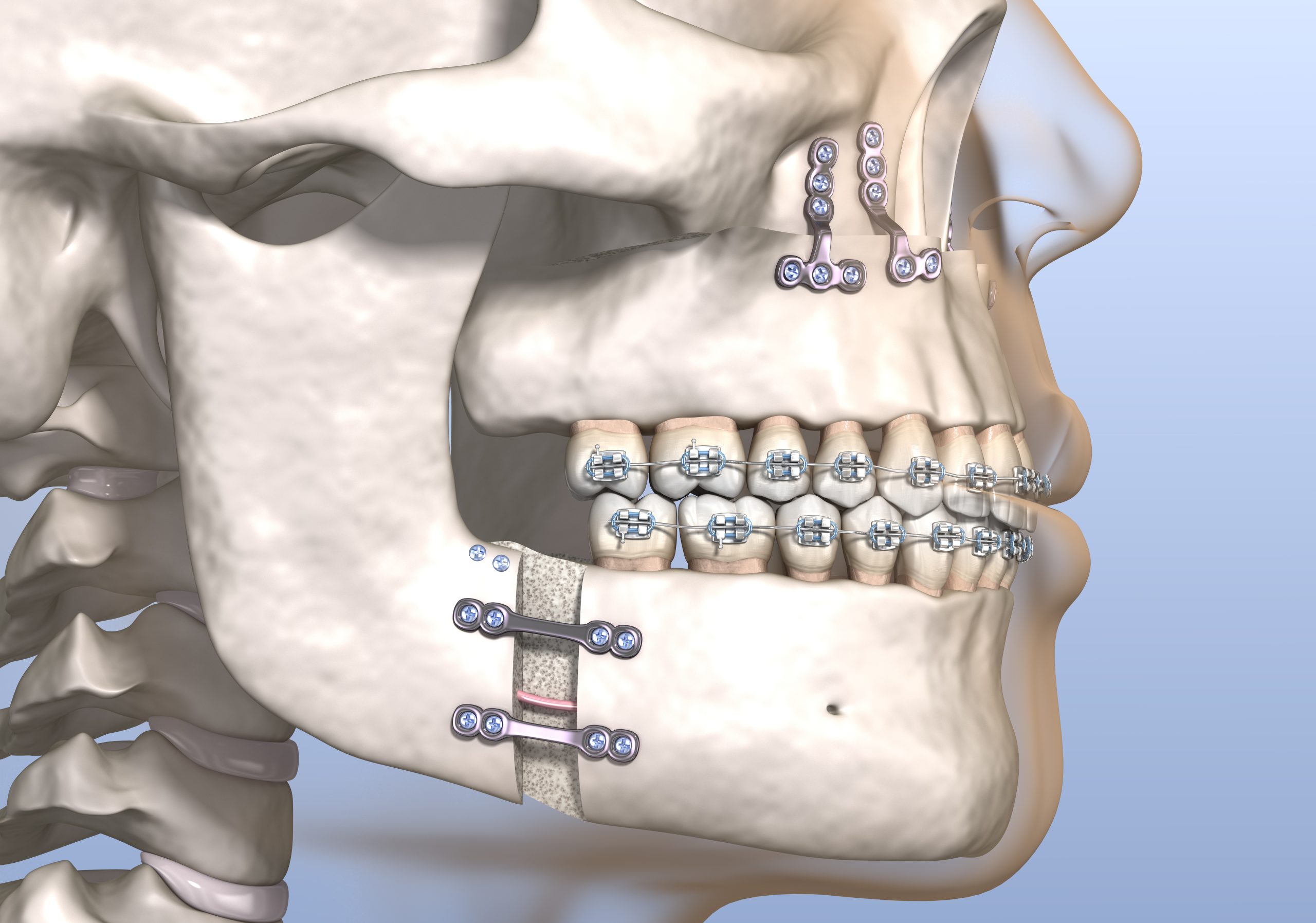Surgical orthodontics
