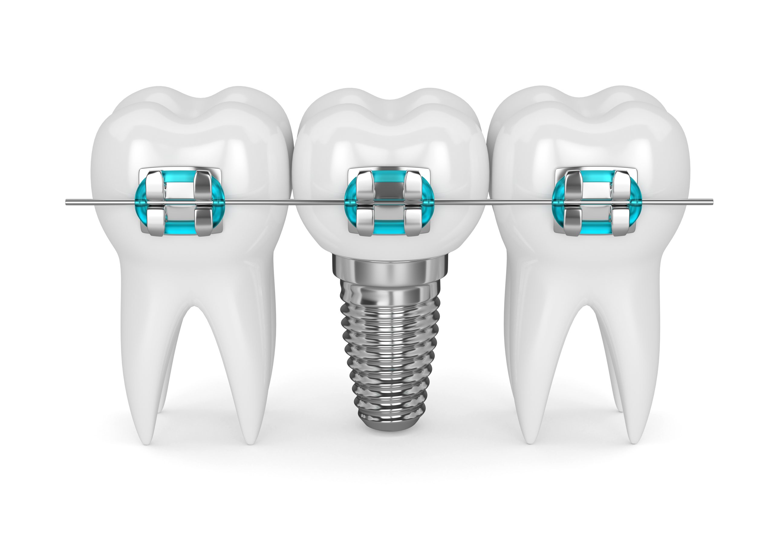 Pre-prosthetic Orthodontics